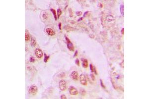 Immunohistochemical analysis of DJ-1 staining in human lung cancer formalin fixed paraffin embedded tissue section.