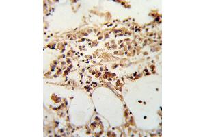 Formalin-fixed and paraffin-embedded human breast carcinoma reacted with TIMP3 Antibody , which was peroxidase-conjugated to the secondary antibody, followed by DAB staining.