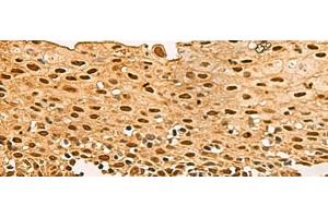 Immunohistochemistry of paraffin-embedded Human cervical cancer tissue using UBLCP1 Polyclonal Antibody at dilution of 1:80(x200) (UBLCP1 anticorps)