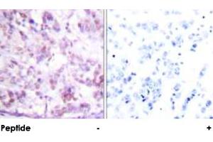 Immunohistochemical analysis of paraffin-embedded human breast carcinoma tissue using MYB polyclonal antibody . (MYB anticorps  (Ser12))