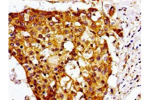 Immunohistochemistry of paraffin-embedded human breast cancer using ABIN7147549 at dilution of 1:100