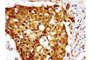 Immunohistochemistry of paraffin-embedded human breast cancer using ABIN7147549 at dilution of 1:100 (CMKLR1 anticorps  (AA 321-373))