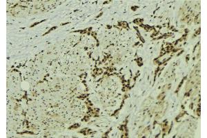 ABIN6273056 at 1/100 staining Human breast cancer tissue by IHC-P. (MMS19 anticorps  (Internal Region))