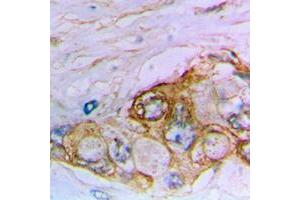 Immunohistochemical analysis of MUC16 staining in human bladder cancer formalin fixed paraffin embedded tissue section. (MUC16 anticorps  (Center))