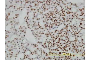 Immunoperoxidase of monoclonal antibody to ZNF143 on formalin-fixed paraffin-embedded human ovary, clear cell carcinoma tissue. (ZNF143 anticorps  (AA 1-626))