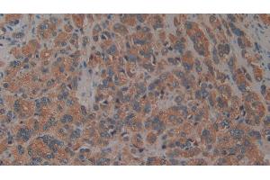 Detection of aZGP1 in Human Prostate cancer Tissue using Polyclonal Antibody to Alpha-2-Glycoprotein 1, Zinc Binding (aZGP1)