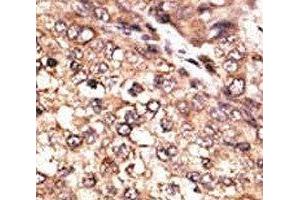 IHC analysis of FFPE human hepatocarcinoma tissue stained with the BMP7 antibody