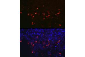 Immunofluorescence analysis of human lung cancer using SFTPC Rabbit pAb (ABIN3015597, ABIN3015598, ABIN3015599, ABIN1682683 and ABIN6218961) at dilution of 1:100 (40x lens).