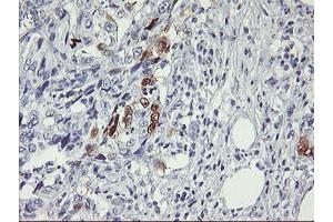 Immunohistochemical staining of paraffin-embedded Carcinoma of Human pancreas tissue using anti-SERPINB2 mouse monoclonal antibody. (SERPINB2 anticorps)