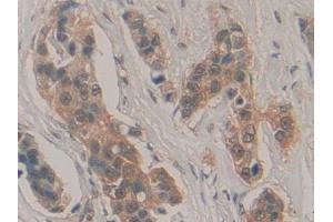 Detection of HPRT1 in Human Breast cancer Tissue using Polyclonal Antibody to Hypoxanthine Phosphoribosyltransferase 1 (HPRT1)