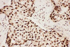 Anti-ALOX5 Picoband antibody,  IHC(P): Human Mammary Cancer Tissue (ALOX5 anticorps  (AA 120-483))