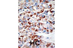 Formalin-fixed and paraffin-embedded human hepatocellular carcinoma tissue reacted with UBA3 polyclonal antibody  , which was peroxidase-conjugated to the secondary antibody, followed by DAB staining. (UBA3 anticorps  (C-Term))