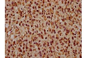 IHC image of ABIN7165222 diluted at 1:1600 and staining in paraffin-embedded human glioma performed on a Leica BondTM system. (CRB2 anticorps  (AA 253-483))
