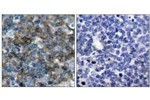 Immunohistochemical analysis of paraffin-embedded human tonsil carcinoma tissue using VASP (phospho-Ser157) antibody (E011214).