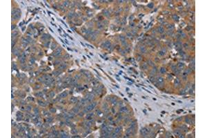 The image on the left is immunohistochemistry of paraffin-embedded Human ovarian cancer tissue using ABIN7191748(OTOR Antibody) at dilution 1/30, on the right is treated with synthetic peptide. (Otoraplin anticorps)