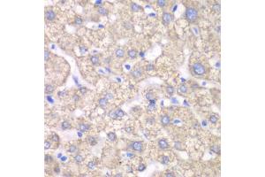Immunohistochemistry of paraffin-embedded human liver injury using ACAT1 antibody (ABIN6292593) at dilution of 1:100 (40x lens). (ACAT1 anticorps)