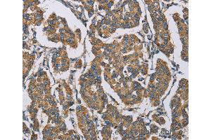 Immunohistochemistry of Human cervical cancer using HDAC6 Polyclonal Antibody at dilution of 1:50 (HDAC6 anticorps)