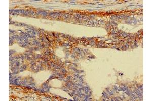 Immunohistochemistry of paraffin-embedded human colon cancer using ABIN7142563 at dilution of 1:100
