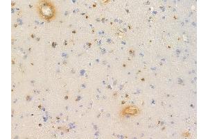 ABIN6256636 and ABIN6267635 at 1/100 staining human glioblastoma by IHC-P. (GRIN2B anticorps  (pTyr1336))