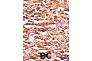 Formalin-fixed and paraffin-embedded human breast cancer tissue reacted with PPP2CA polyclonal antibody  , which was peroxidase-conjugated to the secondary antibody, followed by DAB staining. (PPP2CA anticorps  (N-Term))