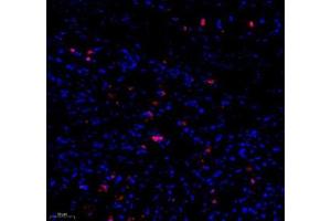 Immunofluorescence of paraffin embedded human stomcah cancer using c-caspase3 (ABIN7073336) at dilution of 1:500 (200x lens)