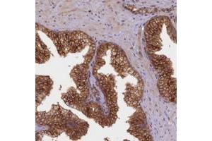 Immunohistochemical staining of human prostate with UFM1 polyclonal antibody  shows strong cytoplasmic positivity in glandular cells. (UFM1 anticorps)