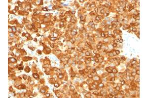 Formalin-fixed, paraffin-embedded human Melanoma stained with gp100 Mouse Monoclonal Antibody (PMEL/783). (Melanoma gp100 anticorps)