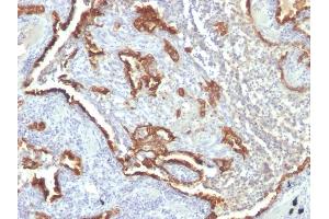 Formalin-fixed, paraffin-embedded human Lung Carcinoma stained with Cytokeratin 7 Monoclonal Antibody (KRT7/760 + OV-TL12/30) (Cytokeratin 7 anticorps)