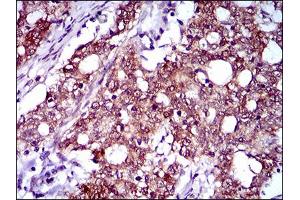 Immunohistochemical analysis of paraffin-embedded cervical cancer tissues using CFLAR mouse mAb with DAB staining. (FLIP anticorps  (AA 100-251))