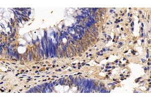 Detection of ERK2 in Human Colorectal cancer Tissue using Polyclonal Antibody to Extracellular Signal Regulated Kinase 2 (ERK2)