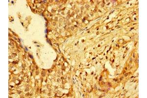 IHC image of ABIN7155213 diluted at 1:300 and staining in paraffin-embedded human cervical cancer performed on a Leica BondTM system.