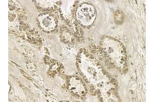 ANP32E Mouse Monoclonal Antibody at 1/100 staining human ovarian cancer by IHC-P.