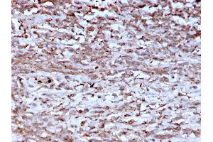 Formalin-fixed, paraffin-embedded human Hepatocellular Carcinoma stained with Cathepsin K Mouse Monoclonal Antibody (CTSK/2793). (Cathepsin K anticorps  (AA 163-274))