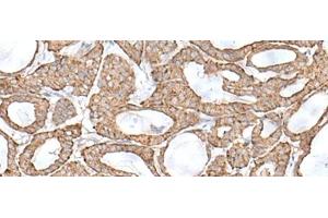Immunohistochemistry of paraffin-embedded Human thyroid cancer tissue using RNF111 Polyclonal Antibody at dilution of 1:50(x200) (RNF111 anticorps)