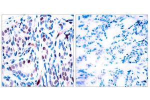 Immunohistochemistry (IHC) image for anti-Signal Transducer and Activator of Transcription 3 (Acute-Phase Response Factor) (STAT3) (pTyr705) antibody (ABIN1847535) (STAT3 anticorps  (pTyr705))