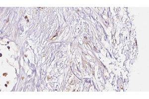 ABIN6273048 at 1/100 staining Human liver cancer tissue by IHC-P. (HLA-F anticorps)