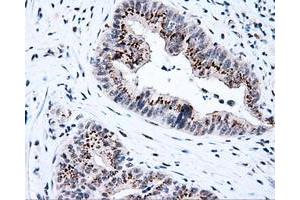 Immunohistochemical staining of paraffin-embedded Adenocarcinoma of colon tissue using anti-KIAA1609 mouse monoclonal antibody. (KIAA1609 anticorps)