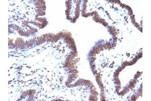 Formalin-fixed, paraffin-embedded human Ovarian Carcinoma stained with EMI1 Mouse Monoclonal Antibody (EMI1/1176).