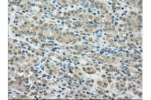 Immunohistochemical staining of paraffin-embedded Carcinoma of thyroid tissue using anti-SSBmouse monoclonal antibody. (SSB anticorps)
