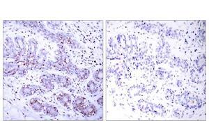 Immunohistochemical analysis of paraffin-embedded human breast carcinoma tissue using STAT4 (Ab-693) antibody (E021047). (STAT4 anticorps)