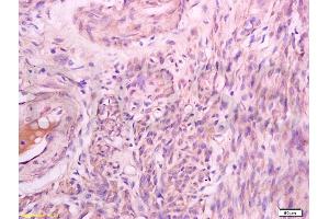 Formalin-fixed and paraffin embedded human endometrium carcinoma labeled with Rabbit Anti Phospho-Talin (Ser425) Polyclonal Antibody, Unconjugated (ABIN703135) at 1:200 followed by conjugation to the secondary antibody and DAB staining