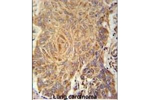 PCYXL Antibody (C-term) (ABIN651800 and ABIN2840404) immunohistochemistry analysis in formalin fixed and paraffin embedded human Lung carcinoma followed by peroxidase conjugation of the secondary antibody and DAB staining. (PCYOX1L anticorps  (C-Term))