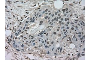 Immunohistochemical staining of paraffin-embedded Carcinoma of kidney tissue using anti-NEK6mouse monoclonal antibody. (NEK6 anticorps)