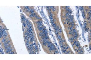 Immunohistochemistry of paraffin-embedded Human colon cancer using HSF27 Polyclonal Antibody at dilution of 1:60 (CDK5RAP3 anticorps)