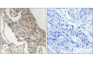 Immunohistochemistry analysis of paraffin-embedded human breast carcinoma, using Gab2 (Phospho-Ser623) Antibody.