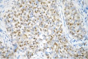 Immunohistochemistry was performed on paraffin-embedded human breast carcinoma using DYNLL1 antibody (ABIN7798403), 1:200).