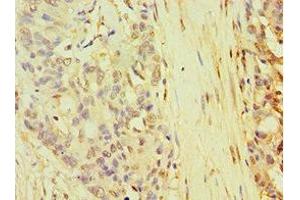 Immunohistochemistry of paraffin-embedded human endometrial cancer using ABIN7168268 at dilution of 1:100 (TARBP2 anticorps  (AA 1-366))