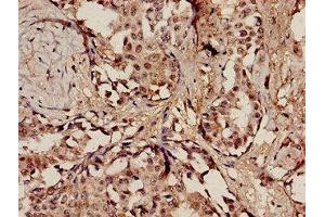 Immunohistochemistry analysis of human breast cancer using ABIN7150239 at dilution of 1:100 (POLE anticorps  (Catalytic Subunit A))