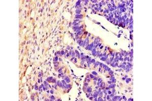 Immunohistochemistry of paraffin-embedded human ovarian cancer using ABIN7167518 at dilution of 1:100 (PTPRS anticorps  (AA 25-128))
