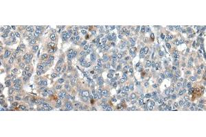 Immunohistochemistry of paraffin-embedded Human liver cancer tissue using CAPN3 Polyclonal Antibody at dilution of 1:30(x200) (Calpain 3 anticorps)